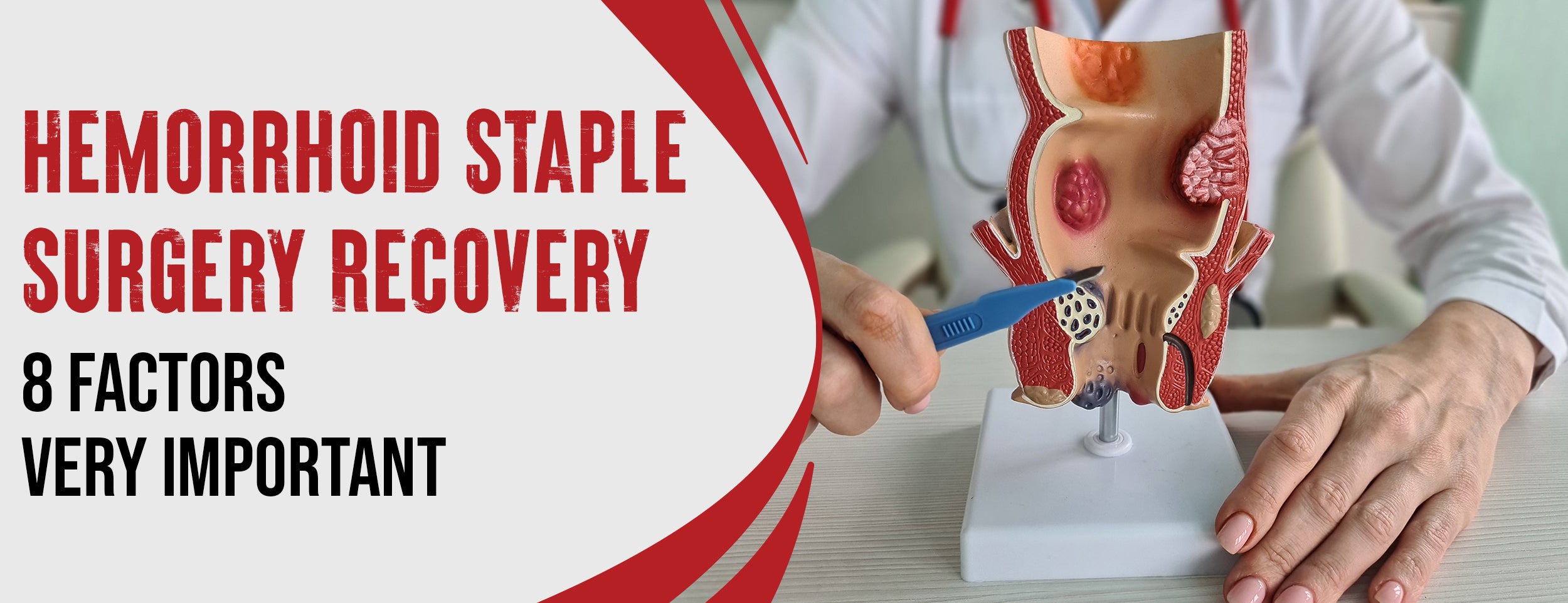 9 Procedures for Hemorrhoid Staple Surgery Recovery