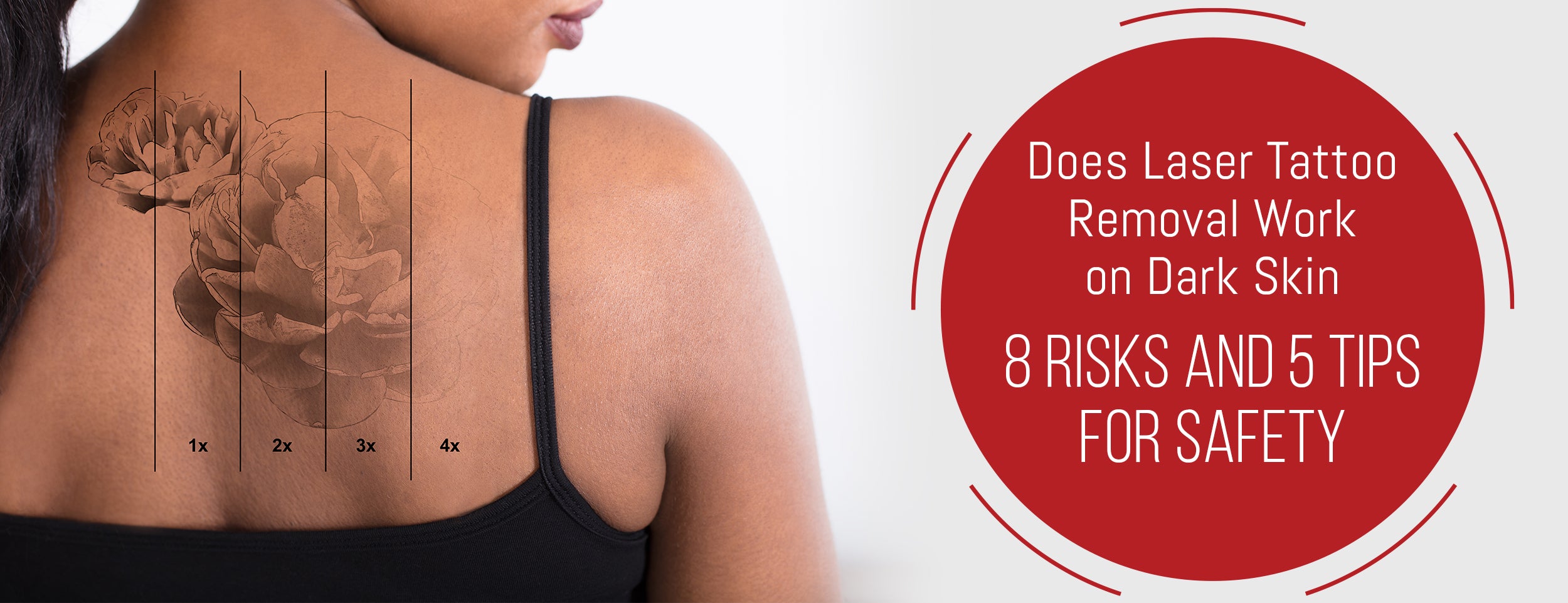 8 Safety Tips for Laser Tattoo Removal on Dark Skin