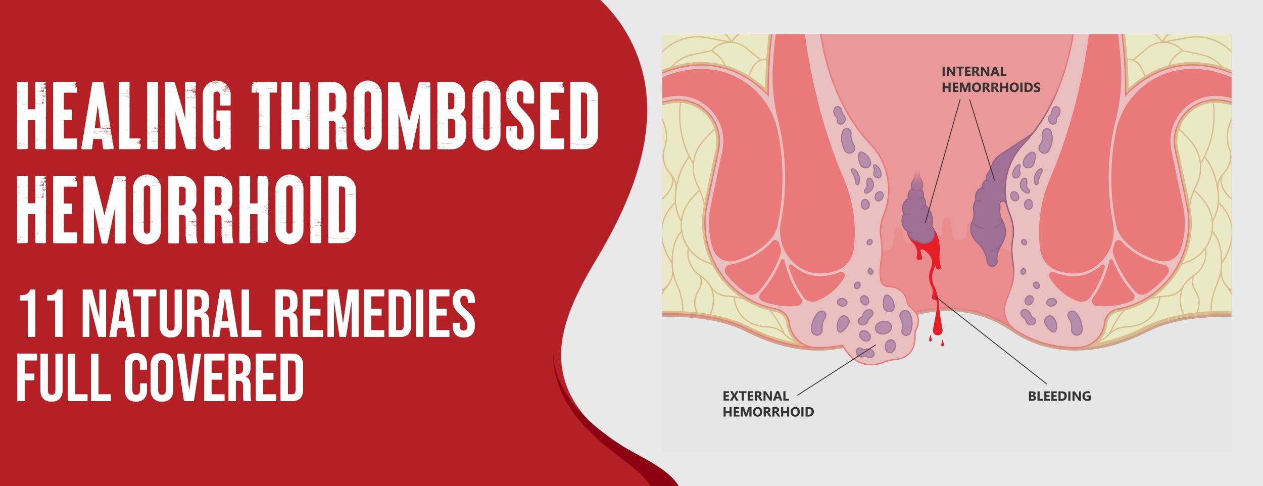 Healing thrombosed hemorrhoid naturally & medically [with home care tips]