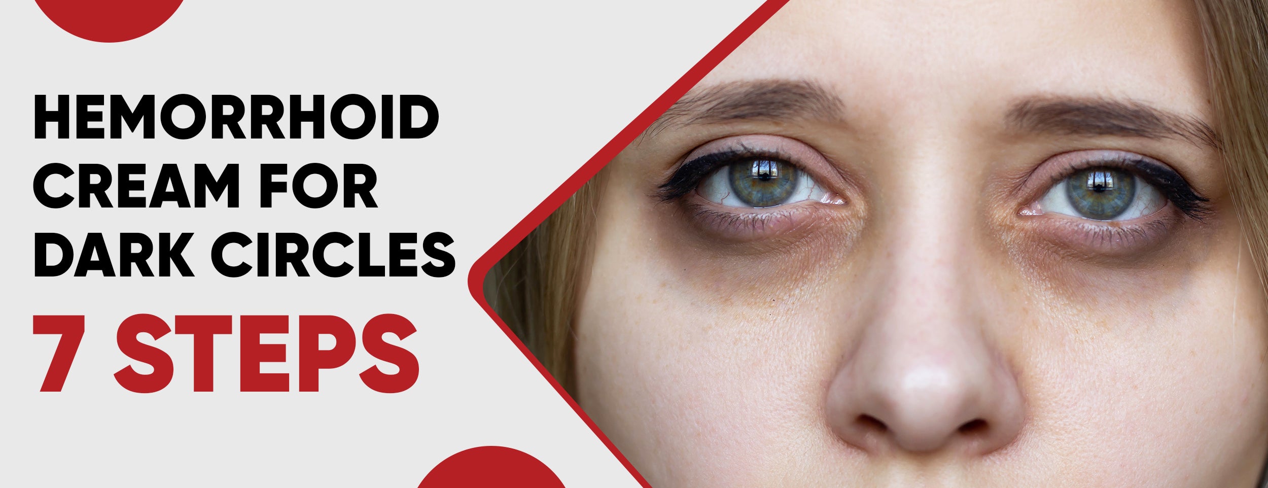 Dark circles caused by hemorrhoids can be treated with a hemorrhoid cream