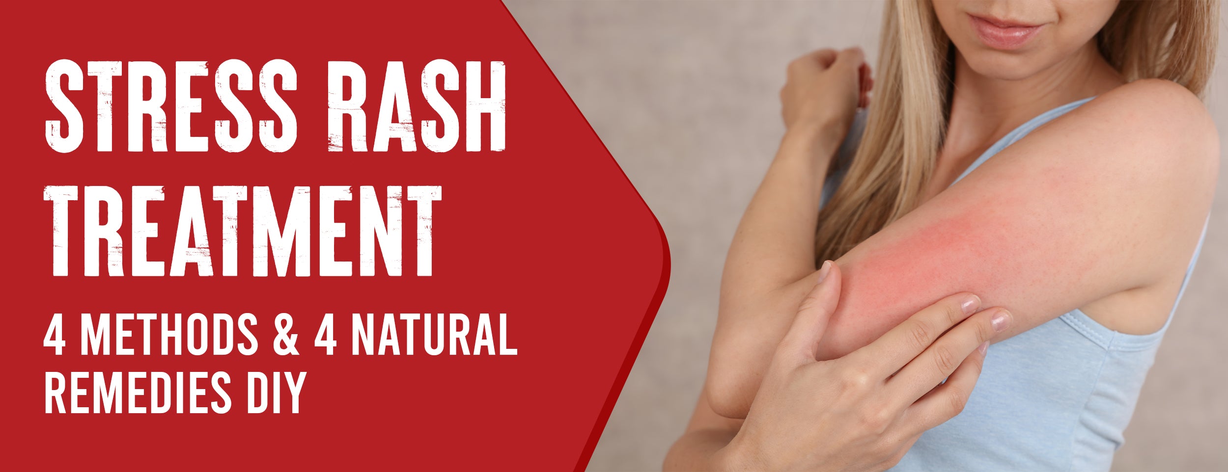 Treatment for Stress Rash: 2 Easy Ways & 4 Prevention Tips