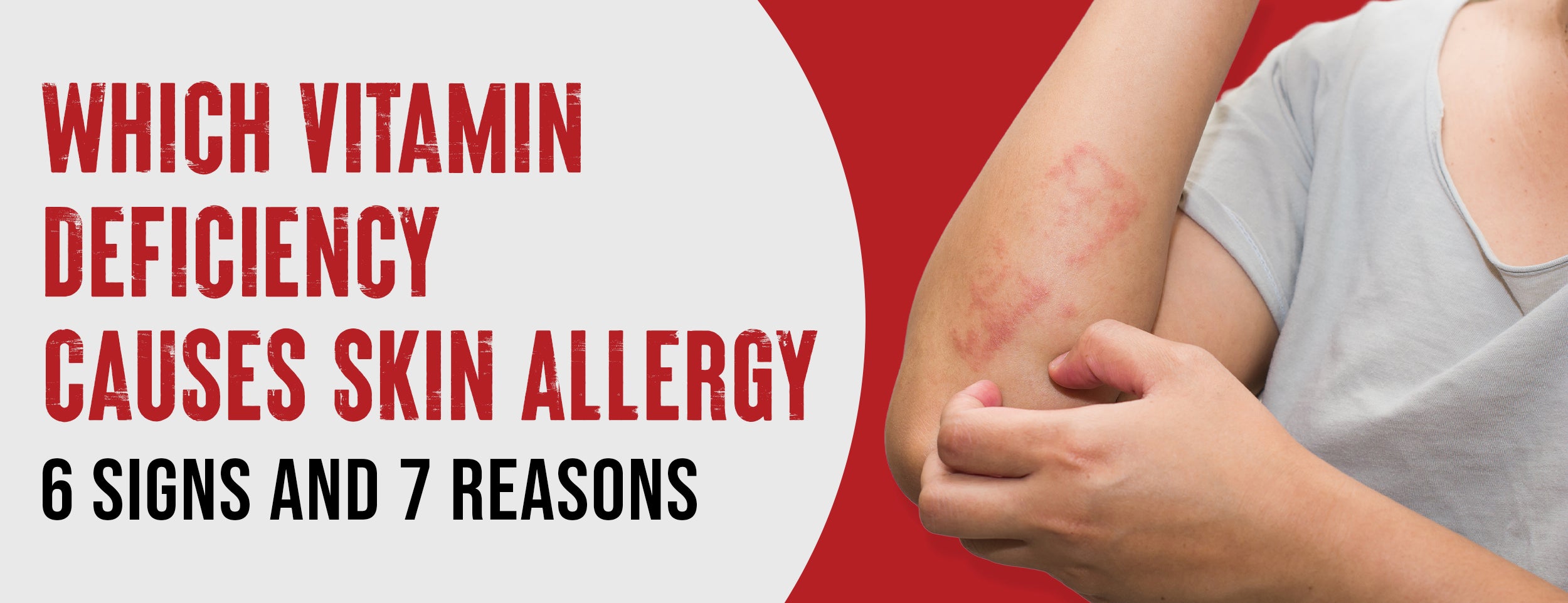 Identifying and preventing skin allergies caused by vitamin deficiency