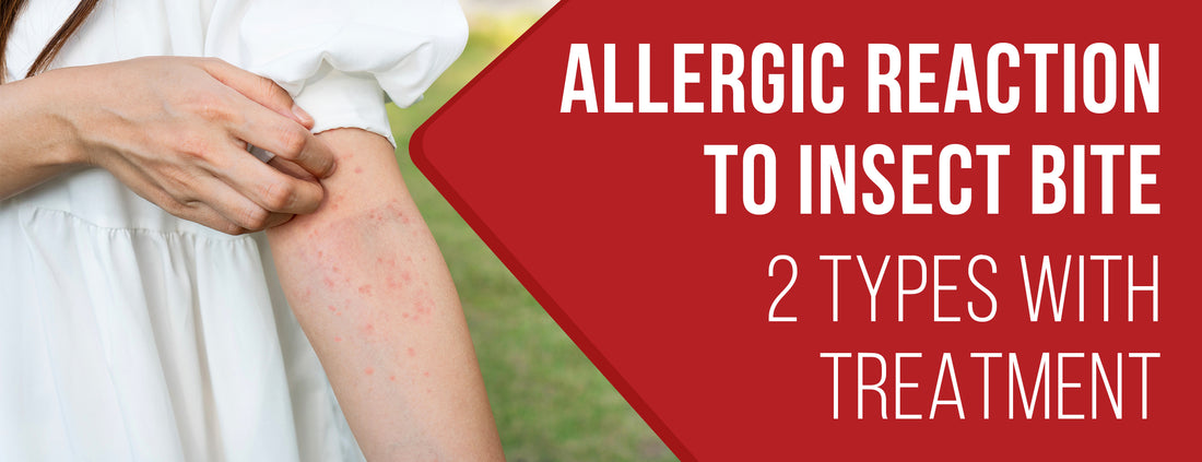 Allergies Types & Treatment Methods for Insect Bite