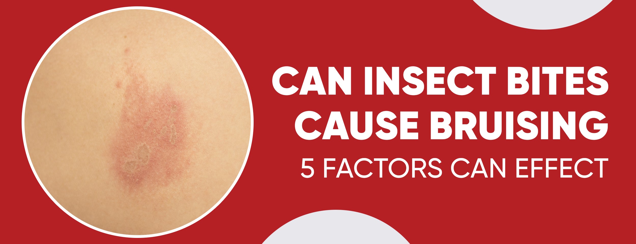 7 reasons and 8 treatments for insect bite bruising