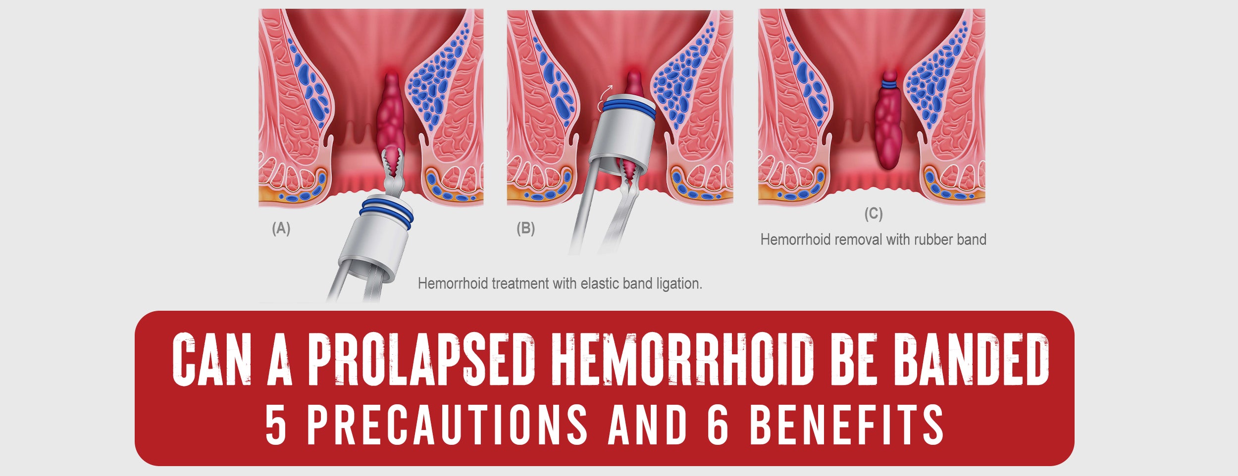 6 Benefits & 5 Precautions of Banding Prolapsed Hemorrhoids