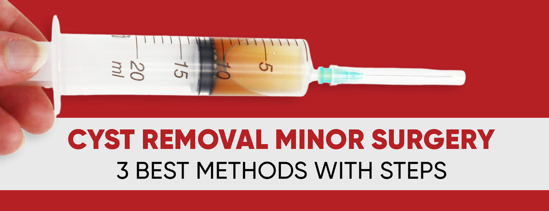 The 3 best methods & indications for cyst removal minor surgery