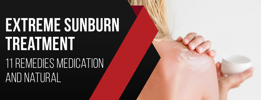 Tips for treating extreme sunburns & what to avoid