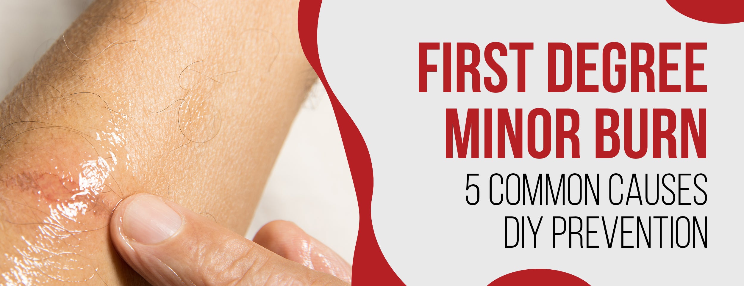 Minor Rug Burns Minor Burn – Dr. Numb®
