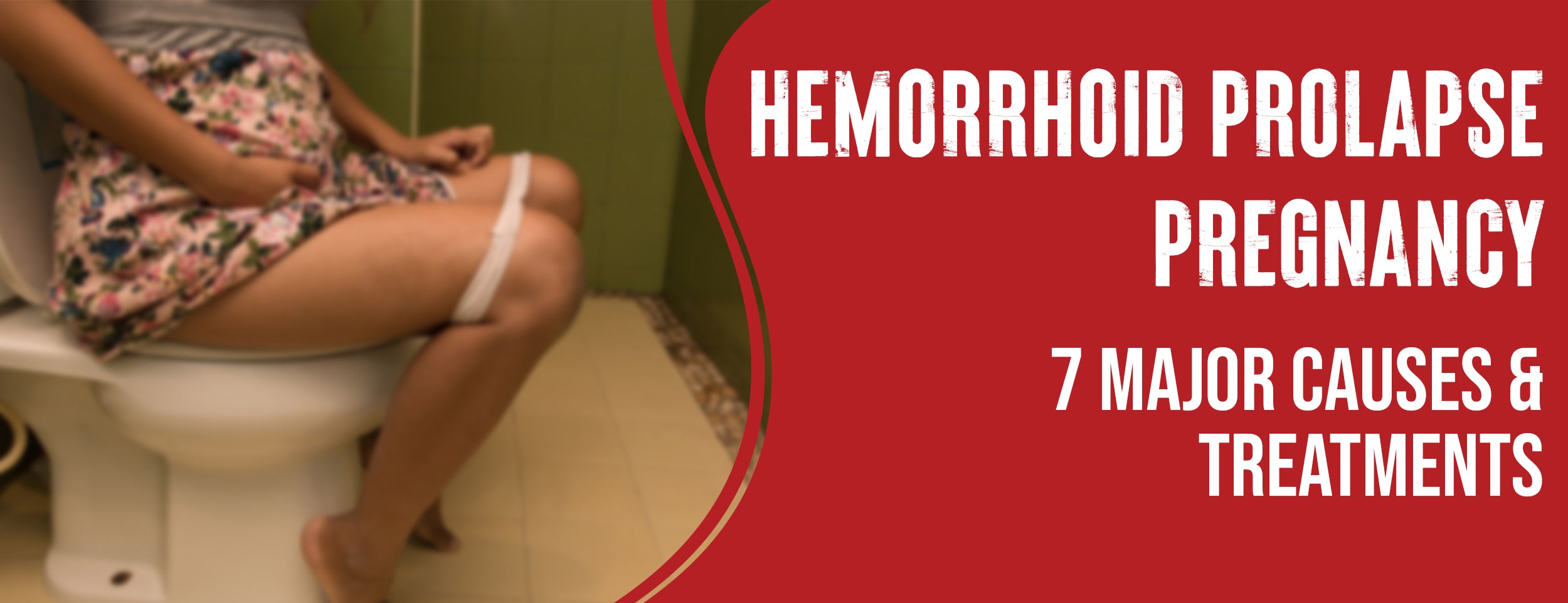 7 Causes & Treatments of Pregnancy Hemorrhoid Prolapse