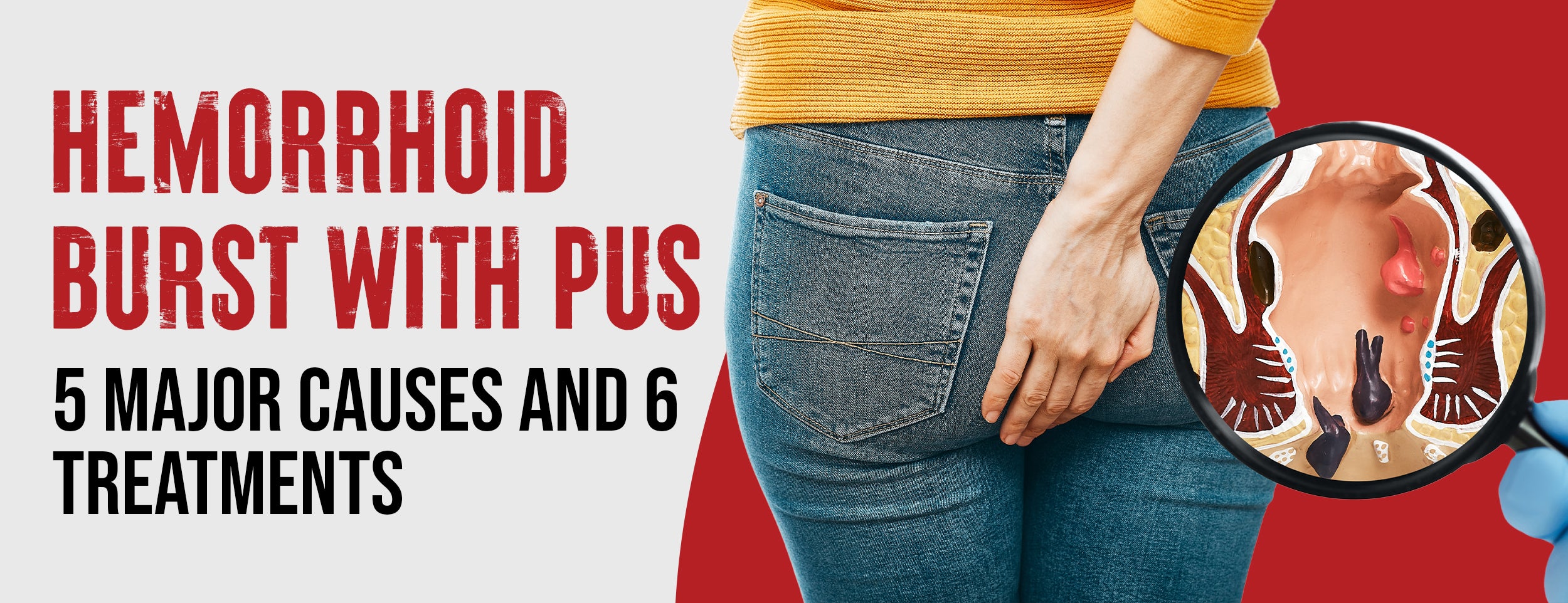 6 Best Treatments for Hemorrhoids with Pus & 5 Major Causes