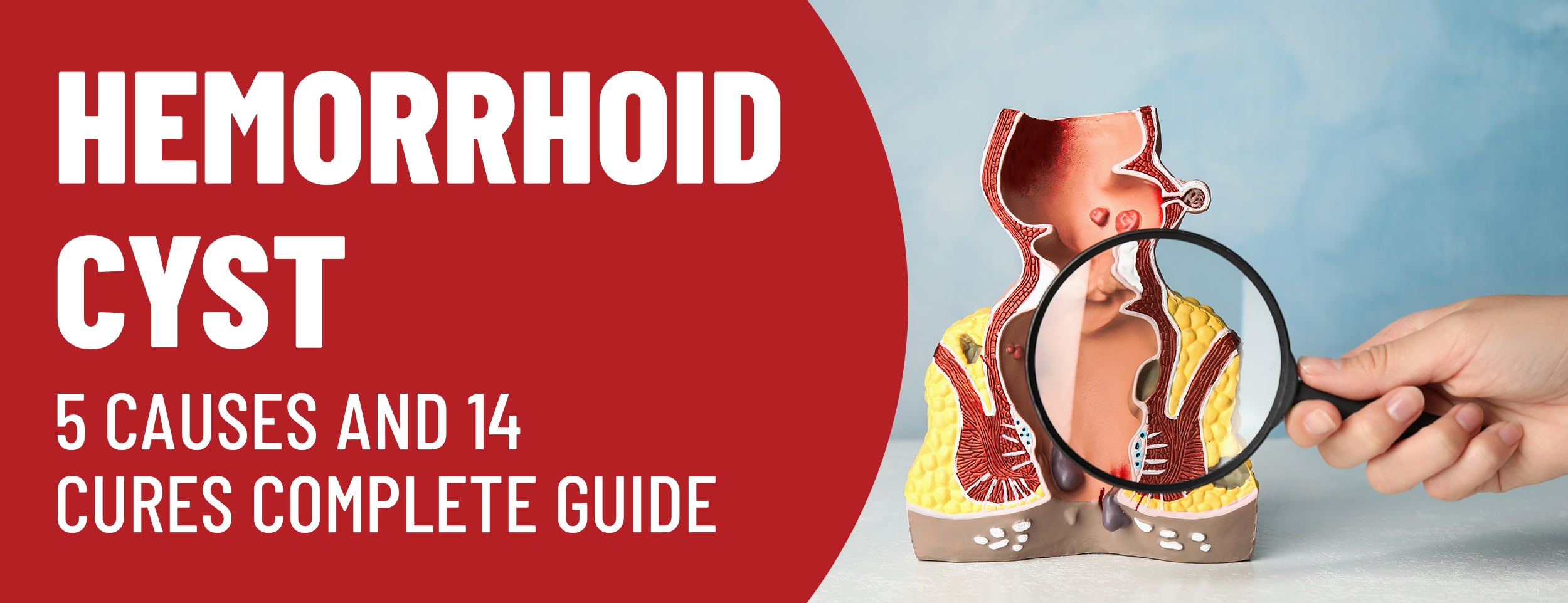 Causes and cures of hemorrhoids
