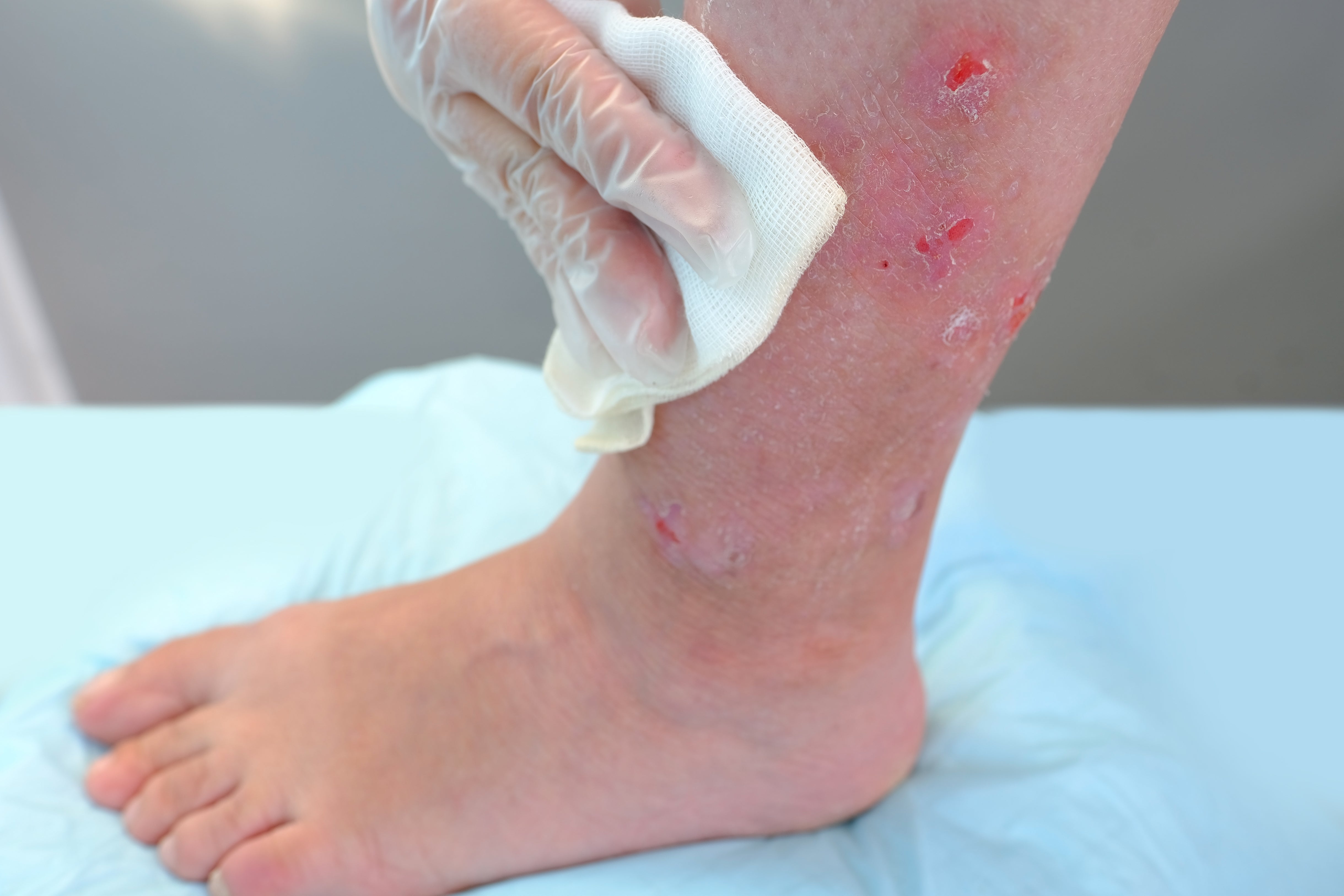  Factors & complications of diabetes that affect wound healing