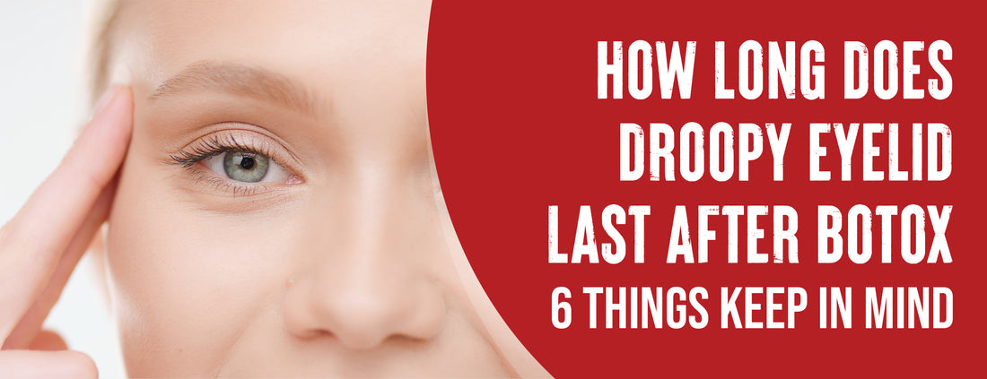 Droopy eyelids can last for a long period of time after botox injections