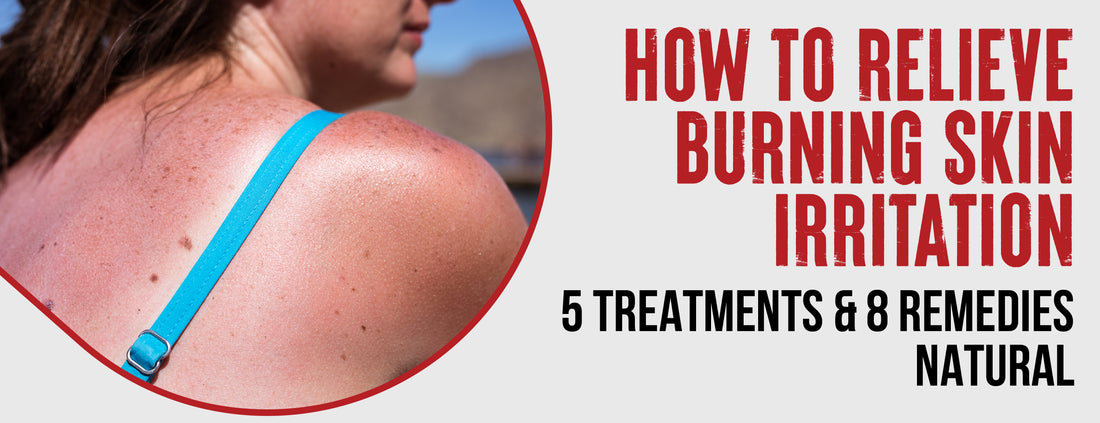 13 Methods & 3 Lifestyle Modifications To Relieve Burning Skin Irritation