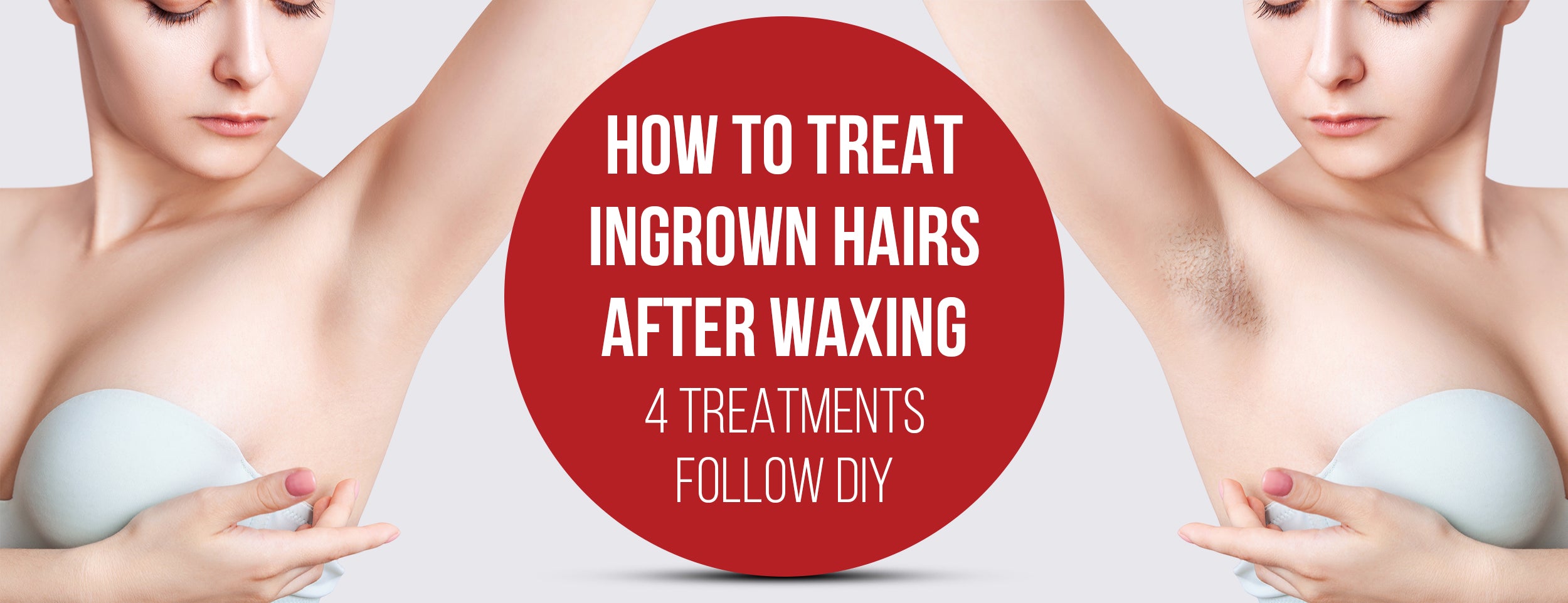 4 Treatments & Prevention Tips for Ingrown Hairs After Waxing