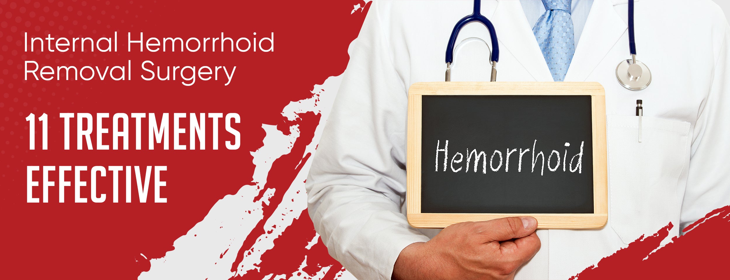 Removing internal hemorrhoids through surgery
