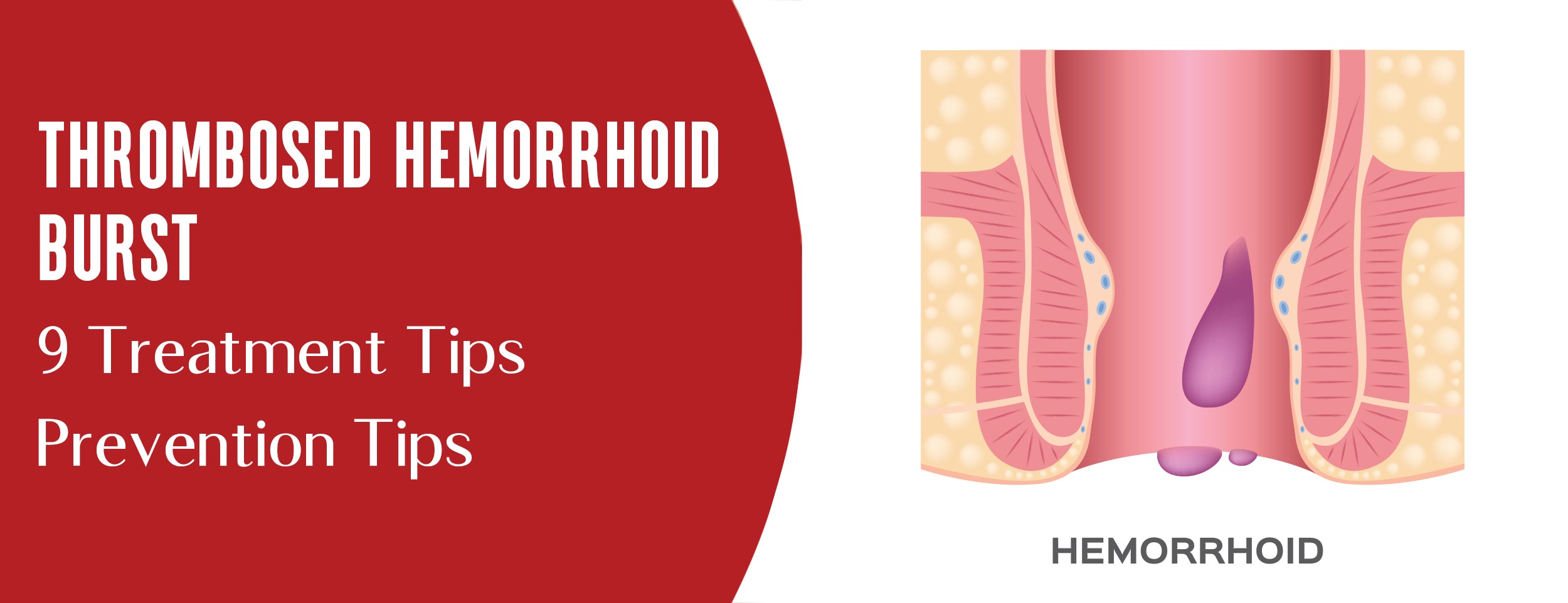 Treatment & Prevention Tips for Thrombosed Hemorrhoids