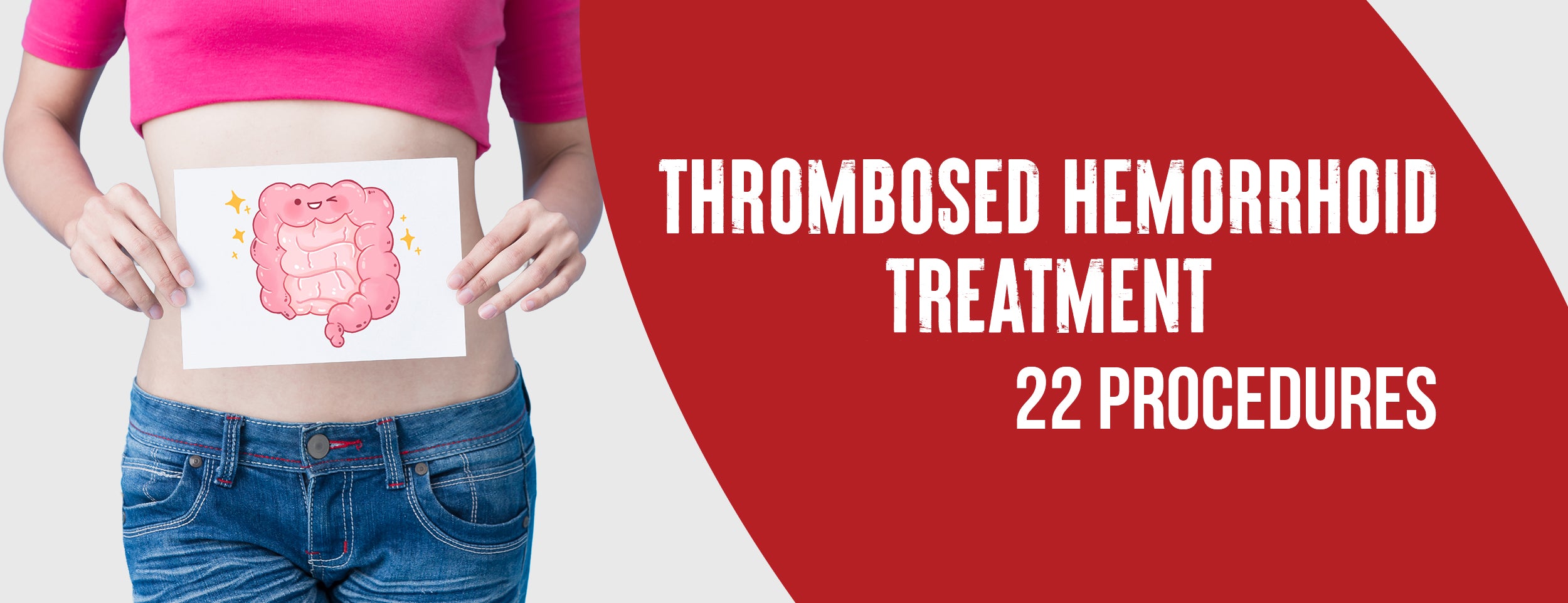 The five most effective medical treatments for thrombosed hemorrhoids